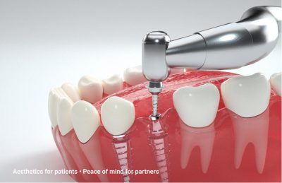 Apply porcelain veneers