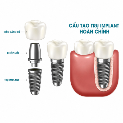 PHỤC HÌNH IMPLANT