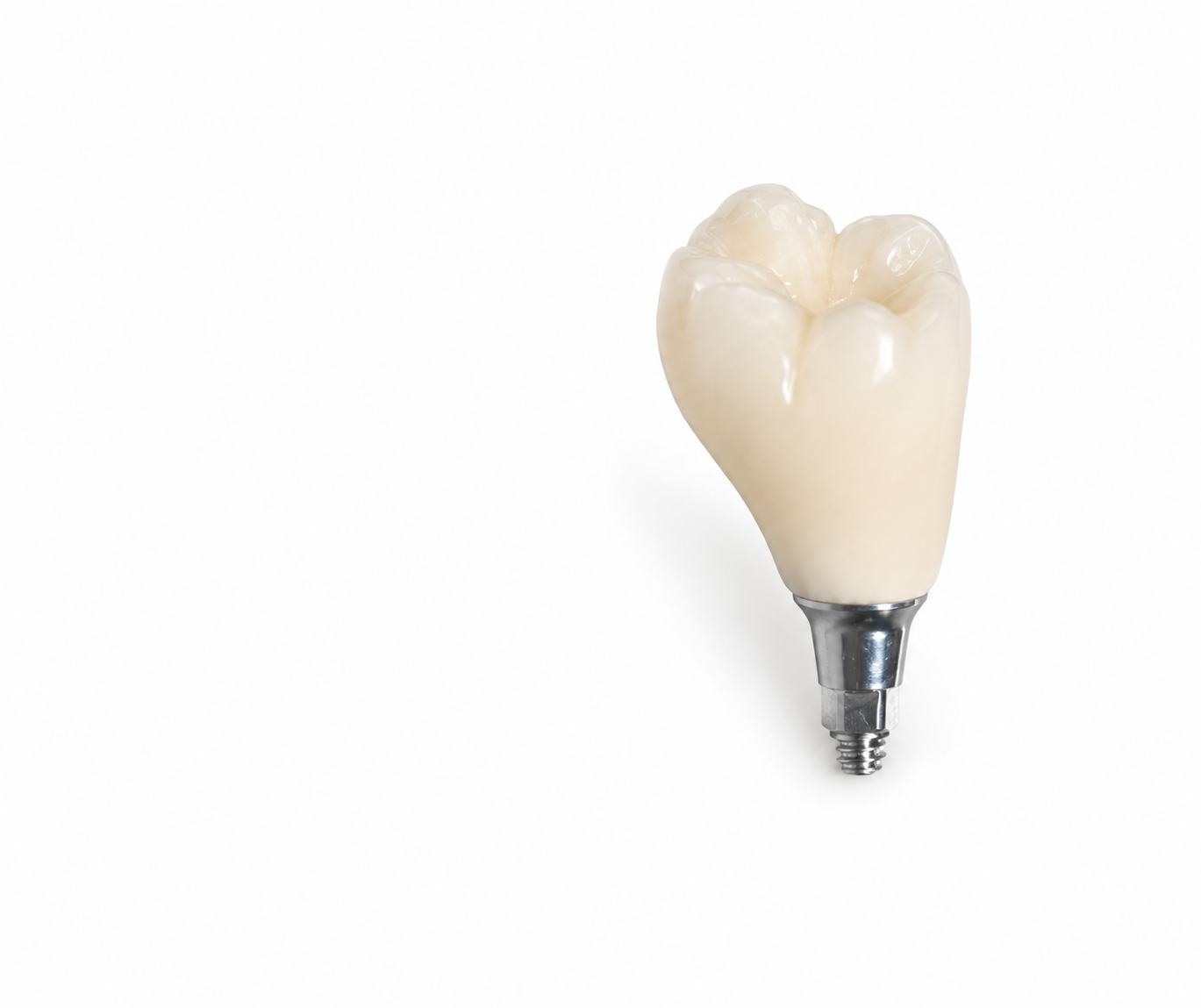 Implant-Supported Restoration - Image 3