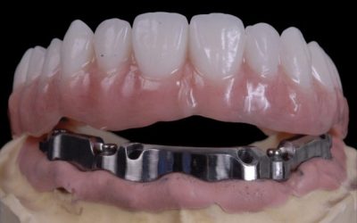 THANH BAR TRÊN IMPLANT
