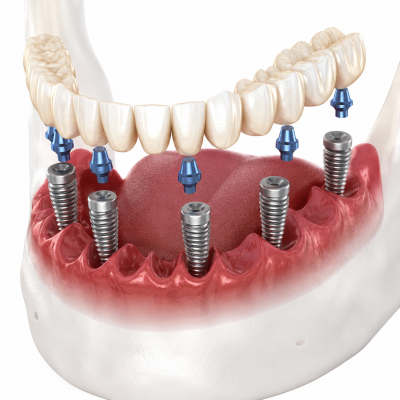 Phục hình implant