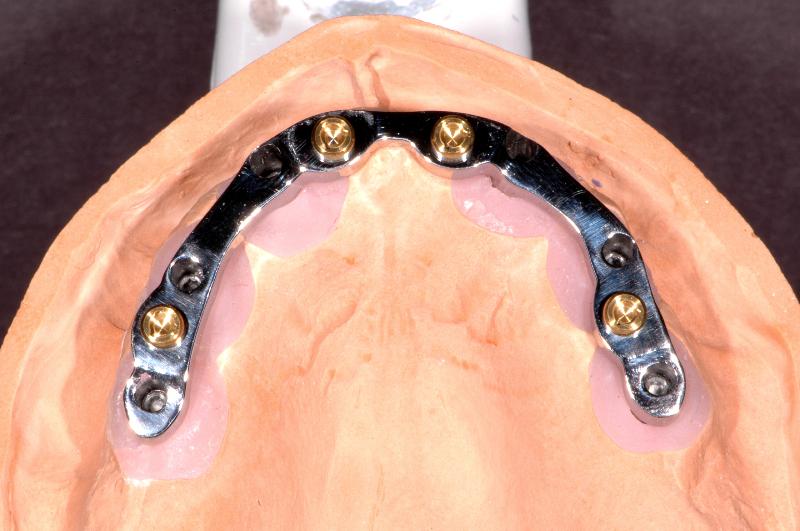 THANH BAR TRÊN IMPLANT - Ảnh 2