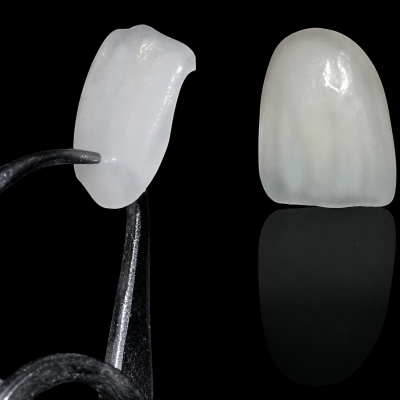 Porcelain Veneers & E.max