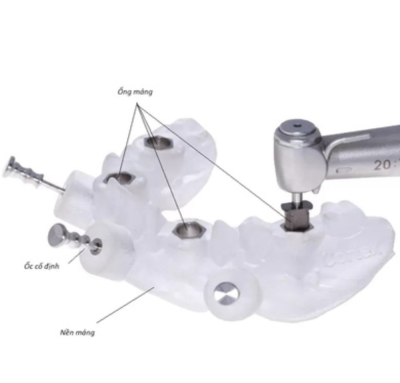 MÁNG PHẪU THUẬT IMPLANT