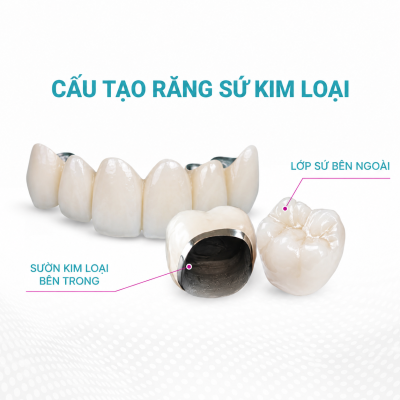 Răng Sứ Kim Loại