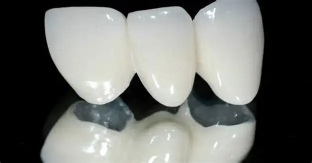 Răng Sứ Chrome Cobalt - Ảnh 3