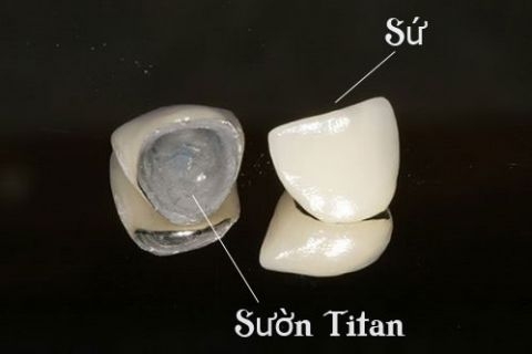 Răng Sứ TiTan - Ảnh 2
